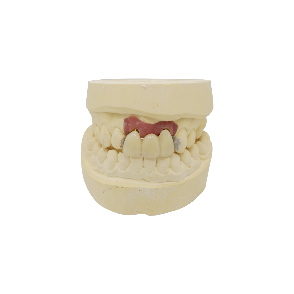 Puente dental implantosoportado