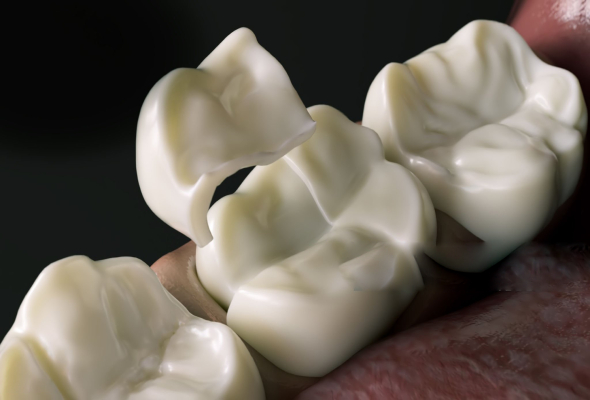 Key Advantages of Composite Inlay and Onlay Restorations