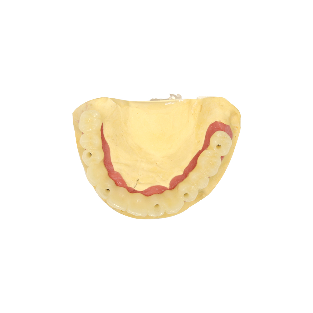 Временни зъби върху импланти (2)