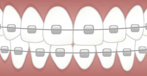 Braces