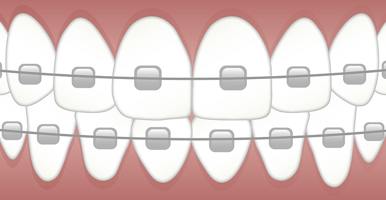 Braces