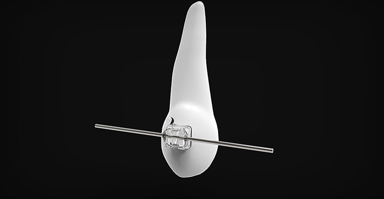 Self-ligating Braces
