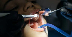 Signs of tooth decay