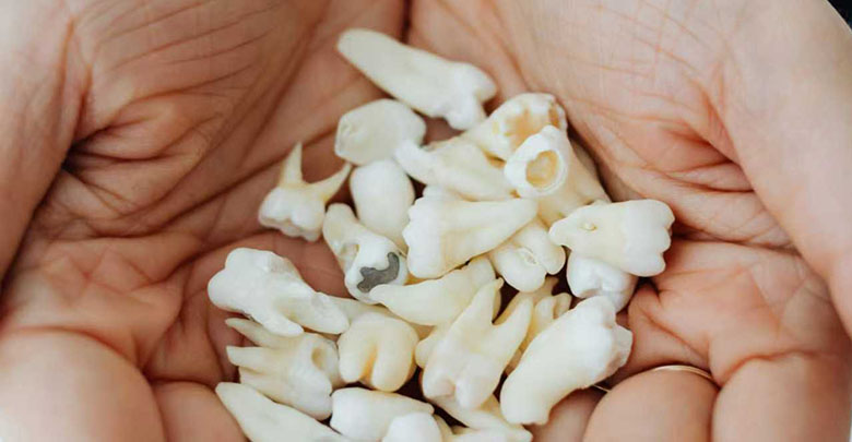 Signs of tooth decay