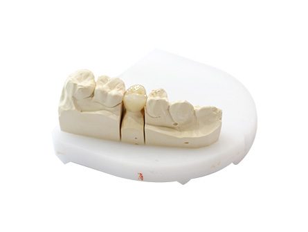 Zirconia a contorno completo Zirconia a contorno completo