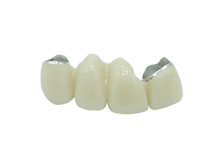 PFM bridge for anterior PFM bridge for anterior