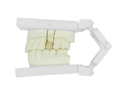 Couronne PFM non précieuse Couronne PFM non précieuse