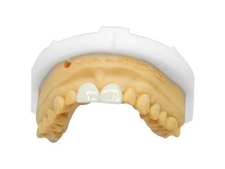 Stampa 3D Ceramica Faccette per denti