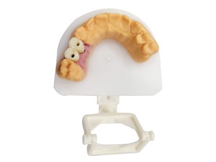 Stampa 3D degli impianti dentali Corona