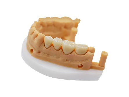 Ponte in zirconia a contorno completo stampato in 3D Ponte in zirconia a contorno completo stampato in 3D