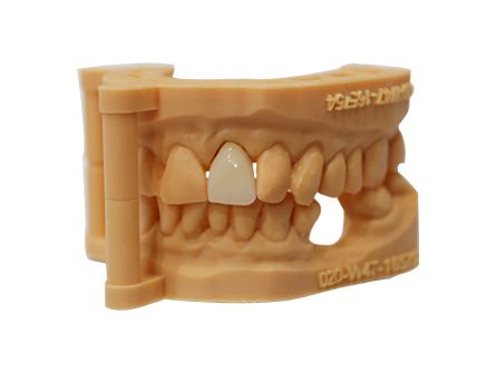 Corona in zirconia stratificata stampata in 3D