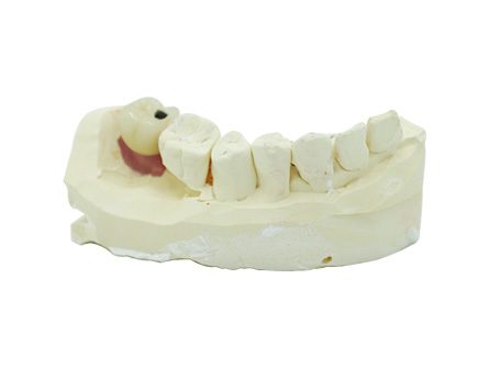 전체 지르코니아 크라운 임플란트 전체 지르코니아 크라운 임플란트