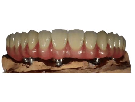 Implant dentaire All-On-4 Implant dentaire All-On-4