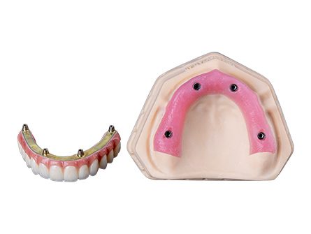 Implants dentaires All On 4 Implants dentaires All On 4