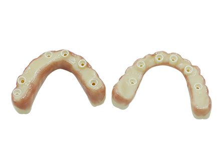 Pont à 6 implants All on Pont à 6 implants All on