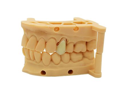 Zementierung der Emax-Krone