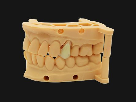 Digital Cosmetic Emax Dental Crown
