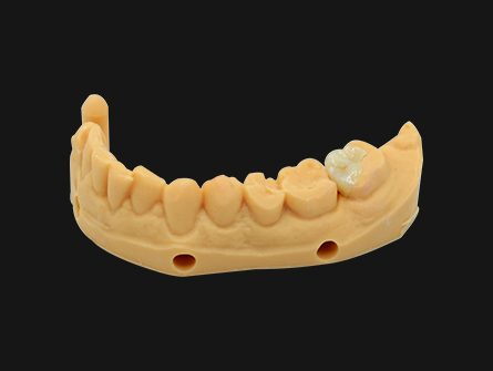 Digital Dental Inlay and Onlay for Teeth