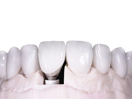 Implant EMAX Implant EMAX