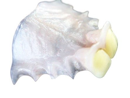 Flexible Teilprothese für obere Frontzähne Flexible Teilprothese für obere Frontzähne