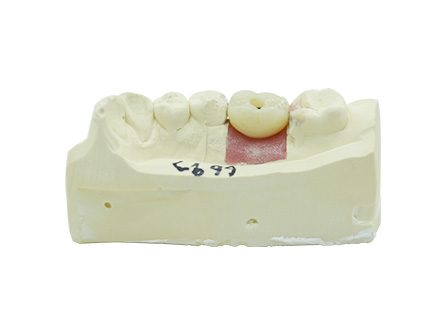 Couronne zircone à contour complet Implant Couronne zircone à contour complet Implant