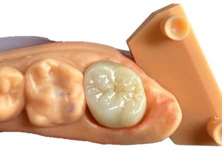 Corona in zirconio a contorno completo Corona in zirconio a contorno completo