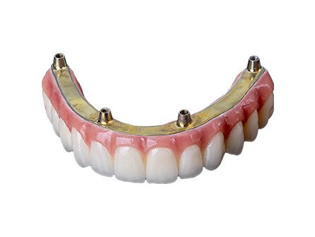 Implants pour prothèses dentaires en bouche (2) Implants pour prothèses dentaires en bouche (2)