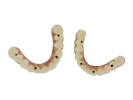 Implants à couronne PFM en bouche complète Implants à couronne PFM en bouche complète