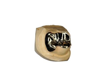 Gold Inlays and Onlays Gold Inlays and Onlays