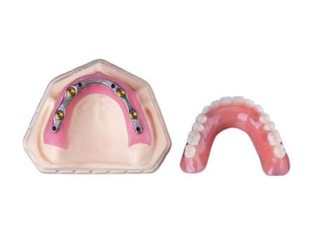 임플란트 틀니 임플란트 틀니