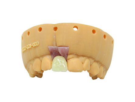 Implant à couronne stratifiée en zircone Implant à couronne stratifiée en zircone