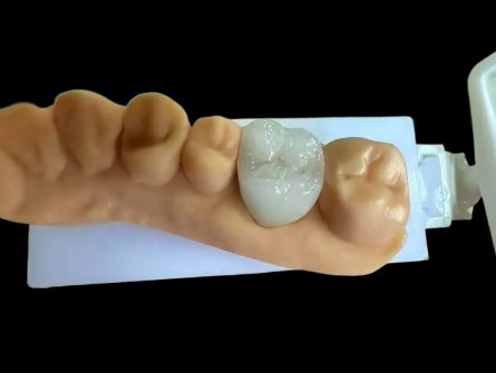 Corona de circonitas en capas