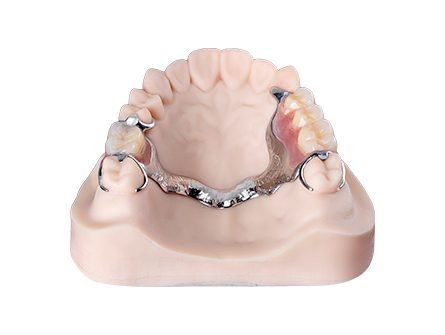 금속 틀니 금속 틀니