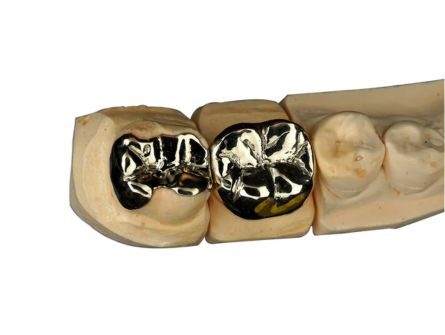 Metal Inlay Onlay Metal Inlay Onlay