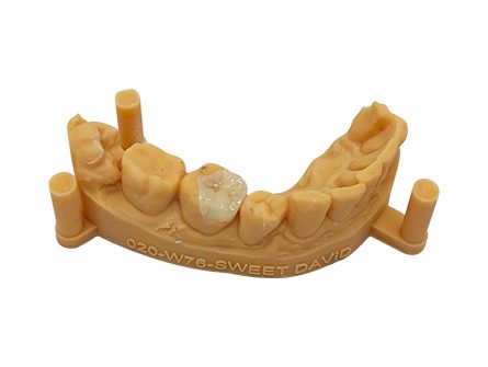 Molar Inlay Molar Inlay