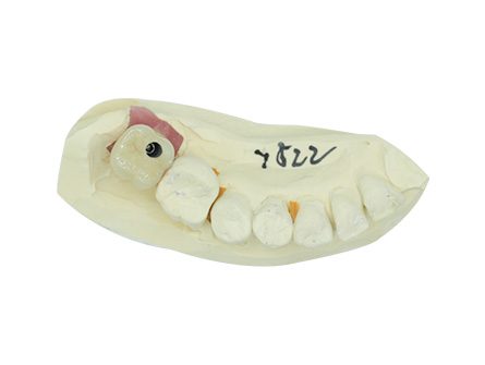Implant d'une seule dent Implant d'une seule dent