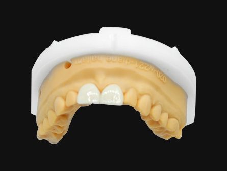 carillas cerámicas de porcelana de aspecto natural