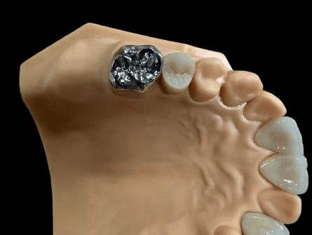 Uzupełnienie z porcelany stapianej z metalem Uzupełnienie z porcelany stapianej z metalem