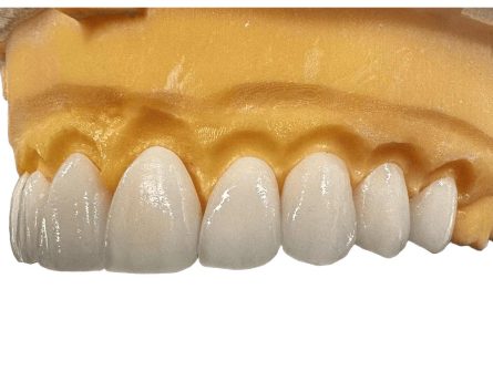 facette en zircone facette en zircone